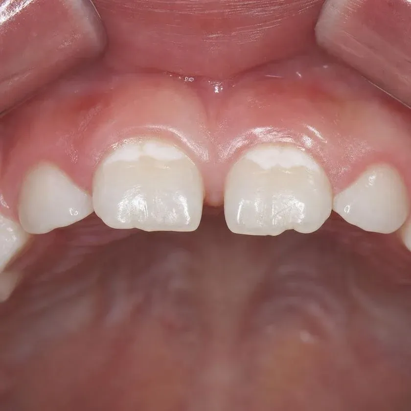 Chalky white spots on the enamel of the front teeth
