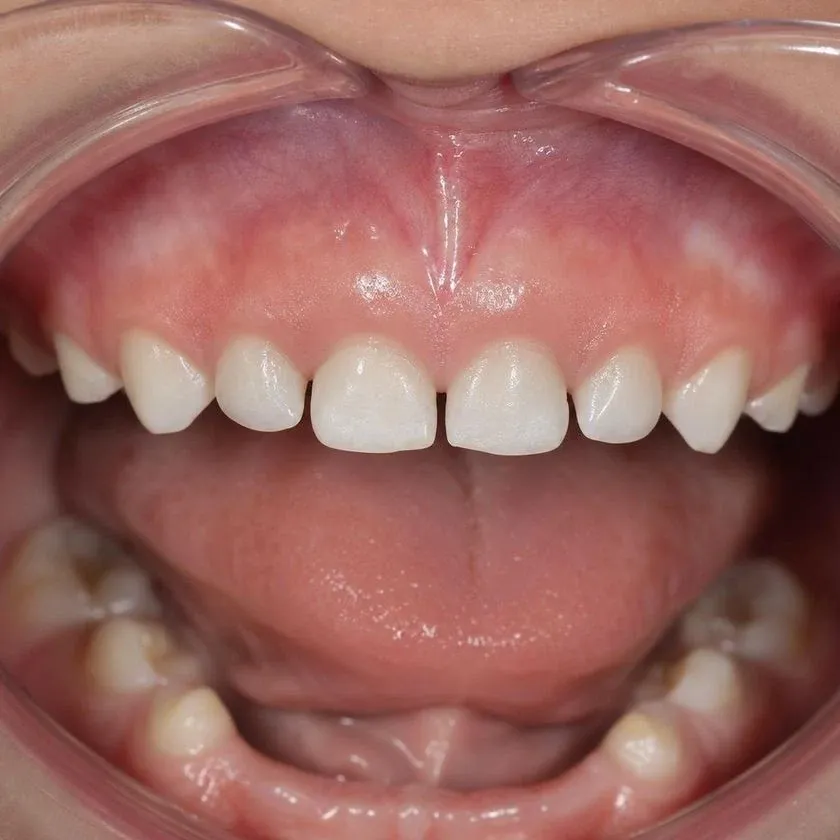 Restored primary front teeth