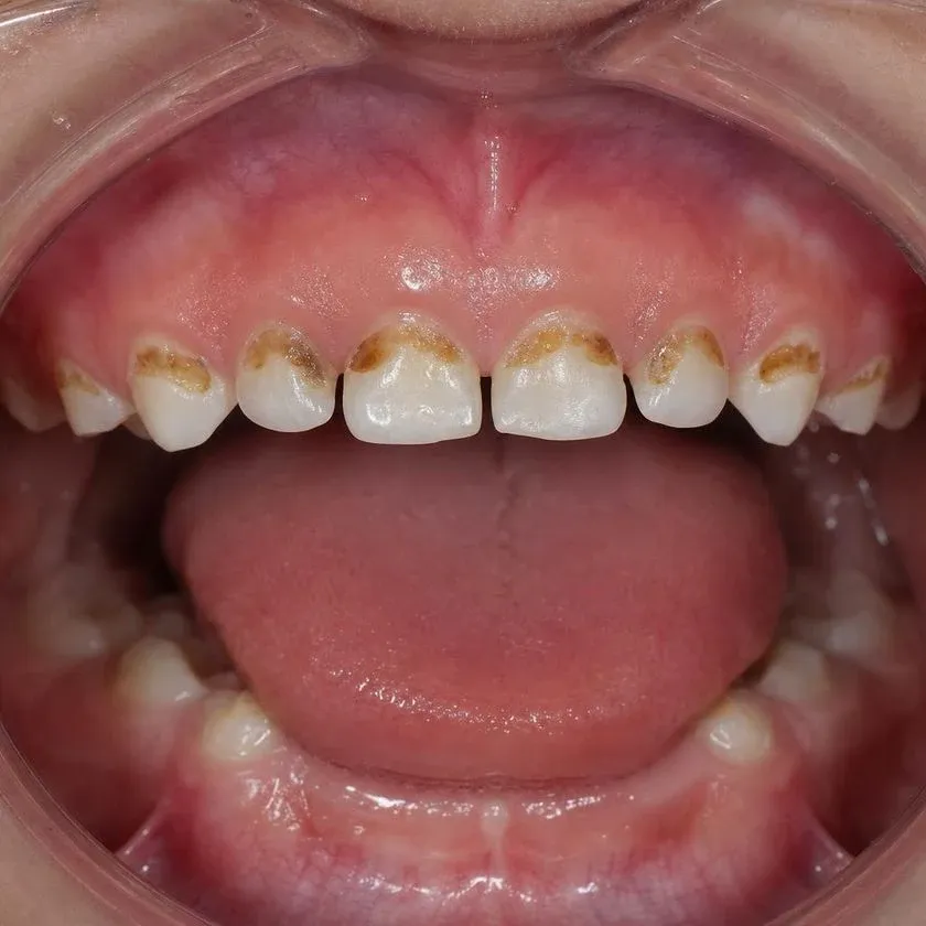 Bottle caries on the front primary teeth