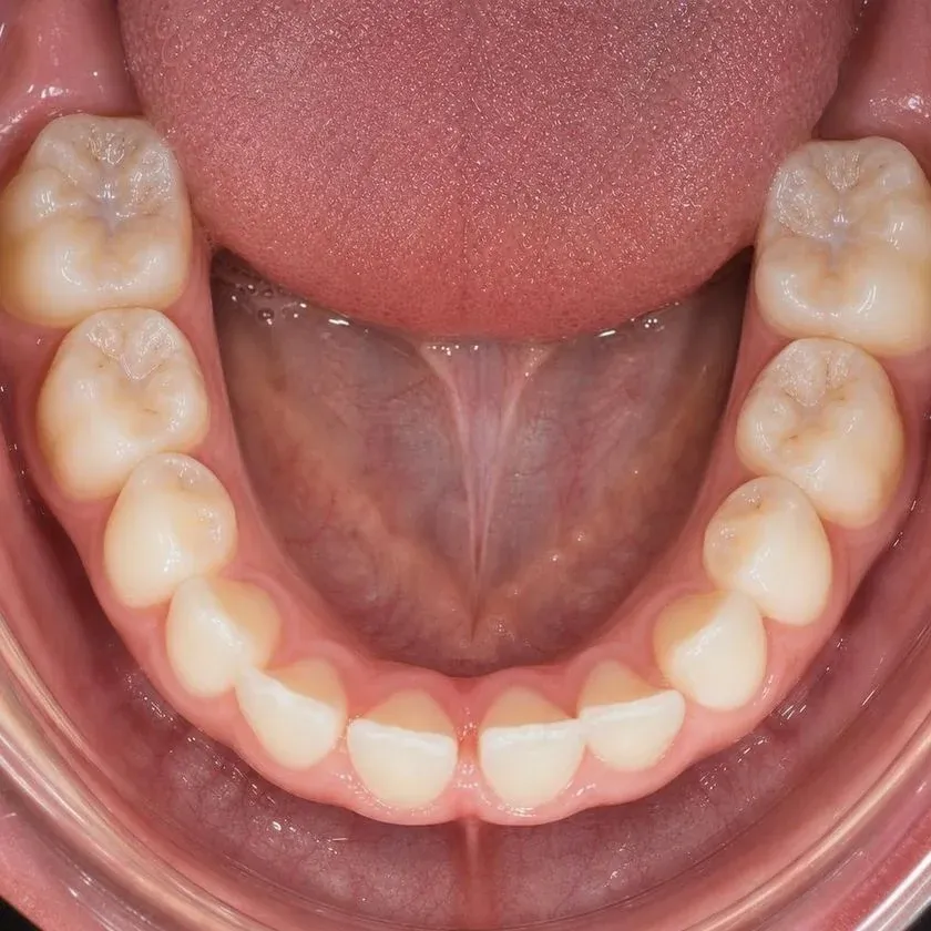 Sealed fissures on permanent molars