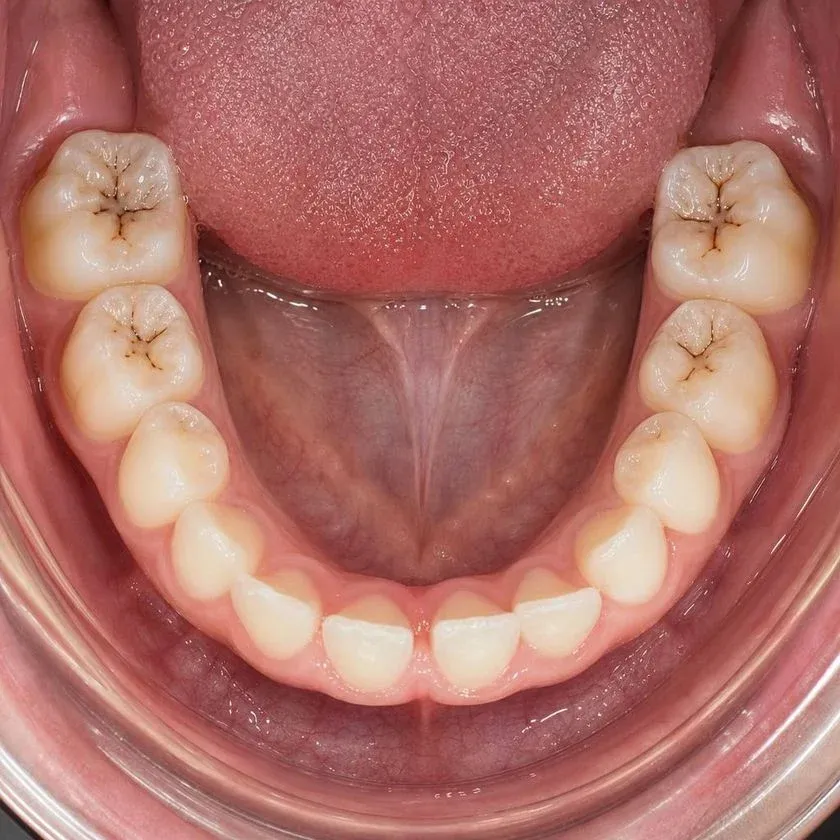 Deep dark fissures on erupted molars