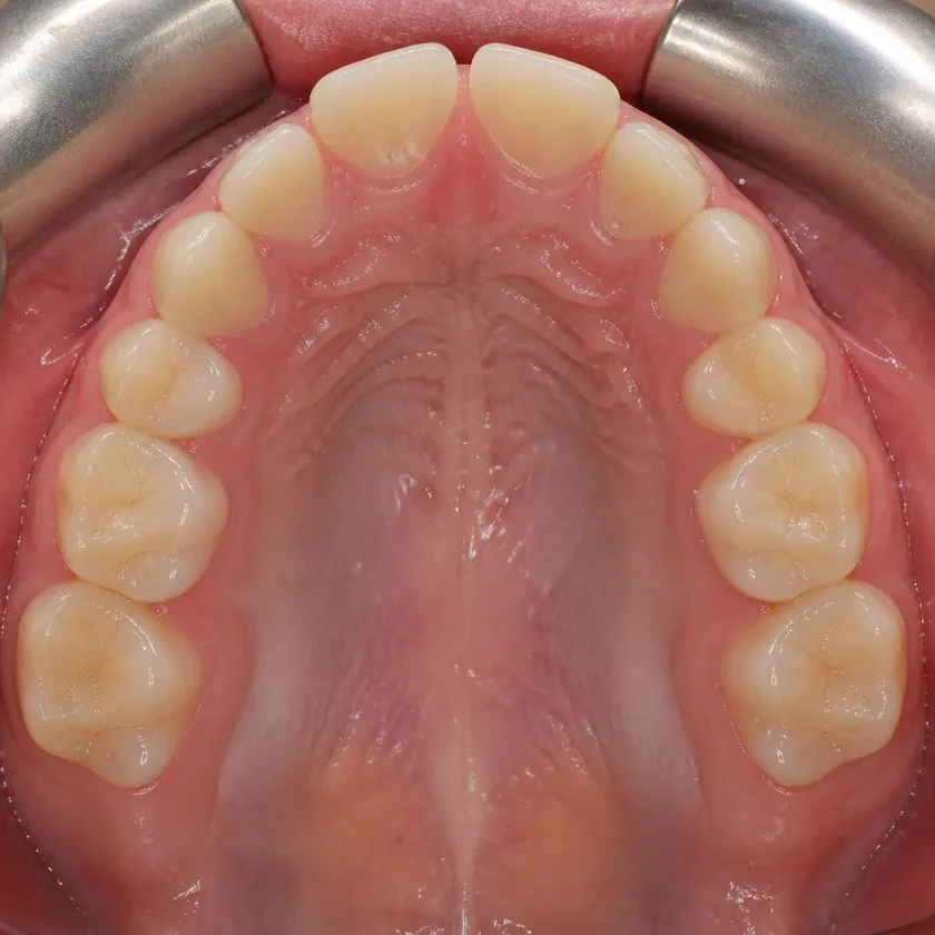 Children's dental plates — post-treatment result shown close-up in a clinical image