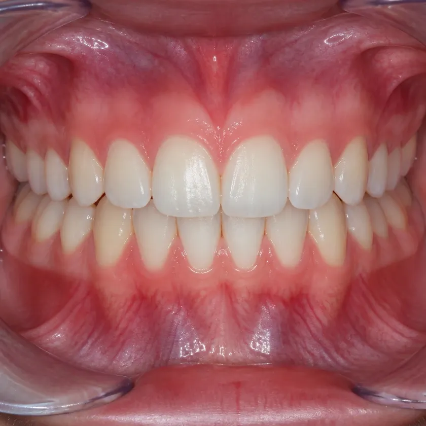 aligners for children — close-up clinical photo of the result after treatment