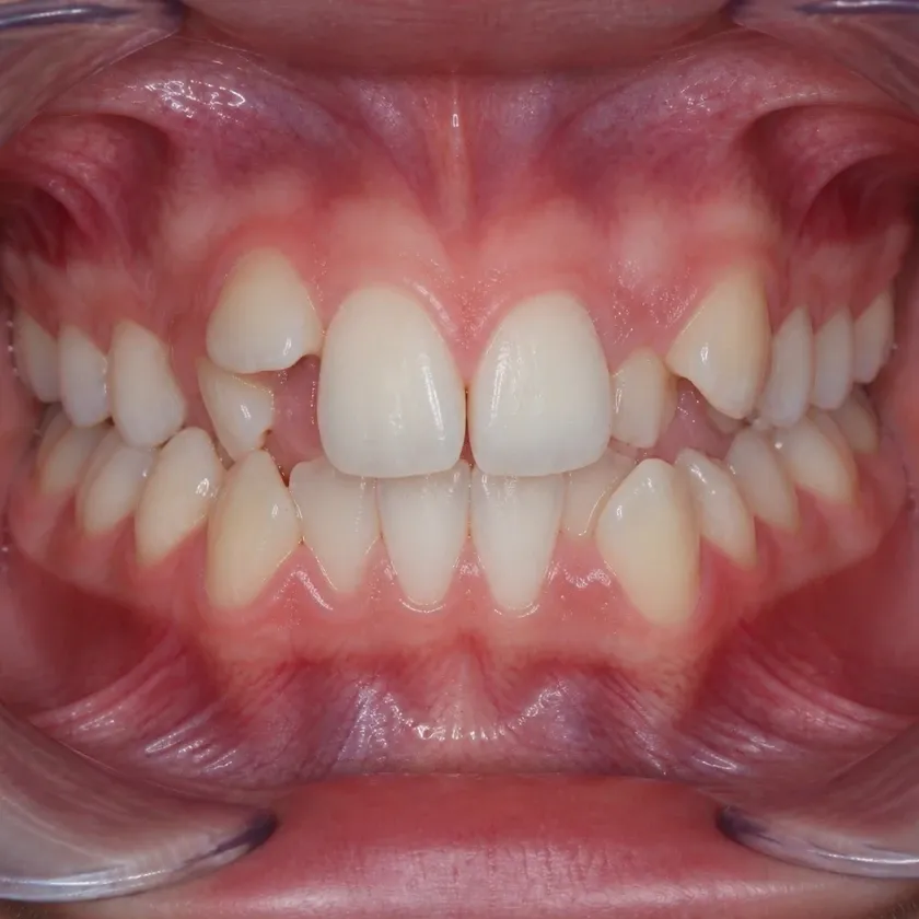 Clear aligners for children — pre-treatment condition in a clinical image
