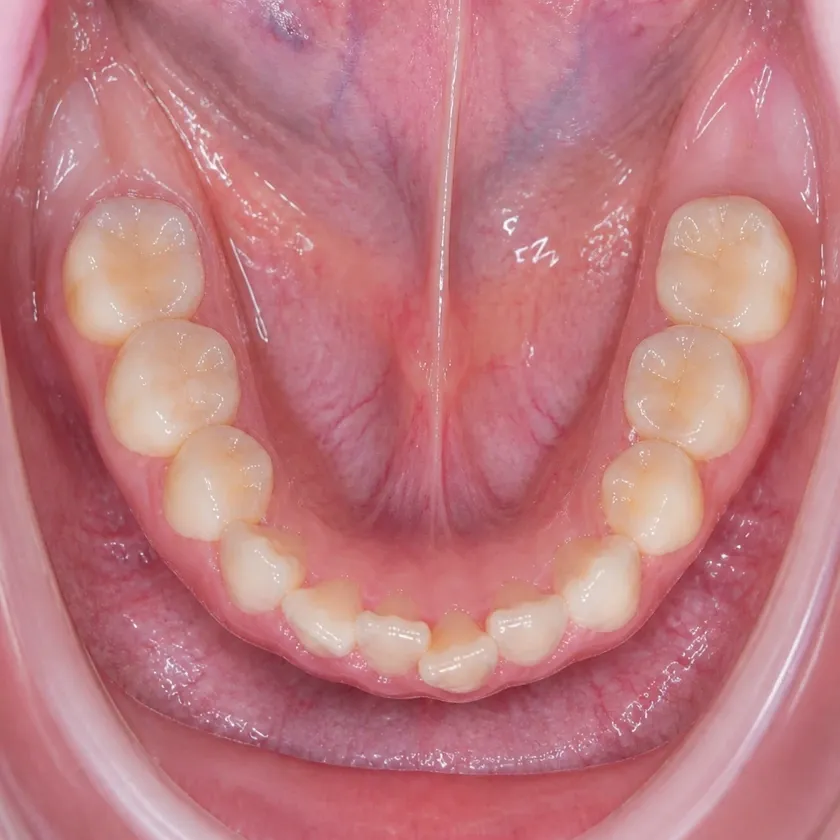 Clear aligners for children — pre-treatment condition in a clinical image