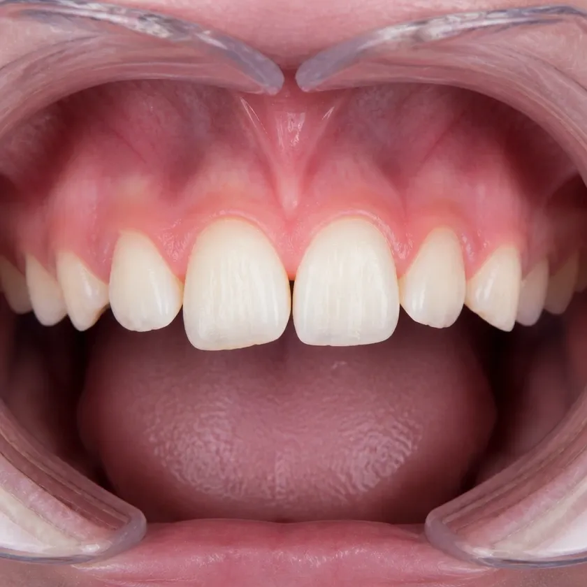 Clear aligners for children — pre-treatment condition in a clinical image