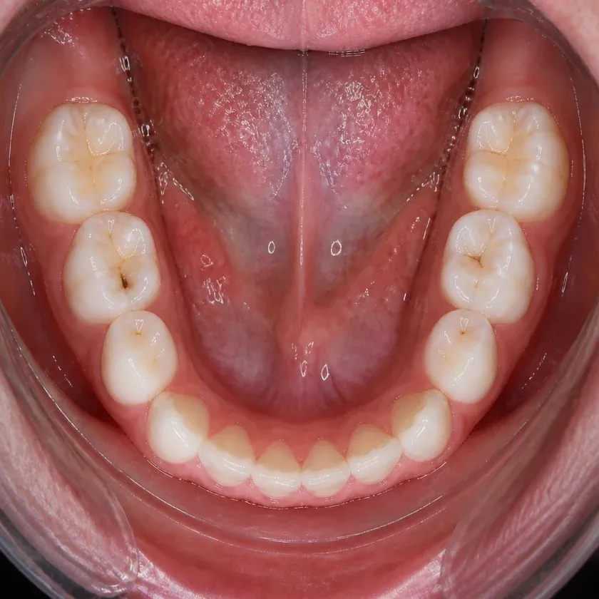 Fluoridation of primary teeth — pre-treatment condition on a clinical image