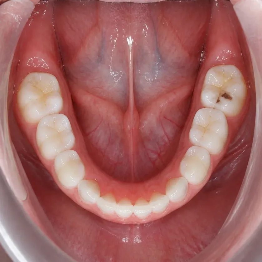 Fluoridation of primary teeth — pre-treatment condition on a clinical image
