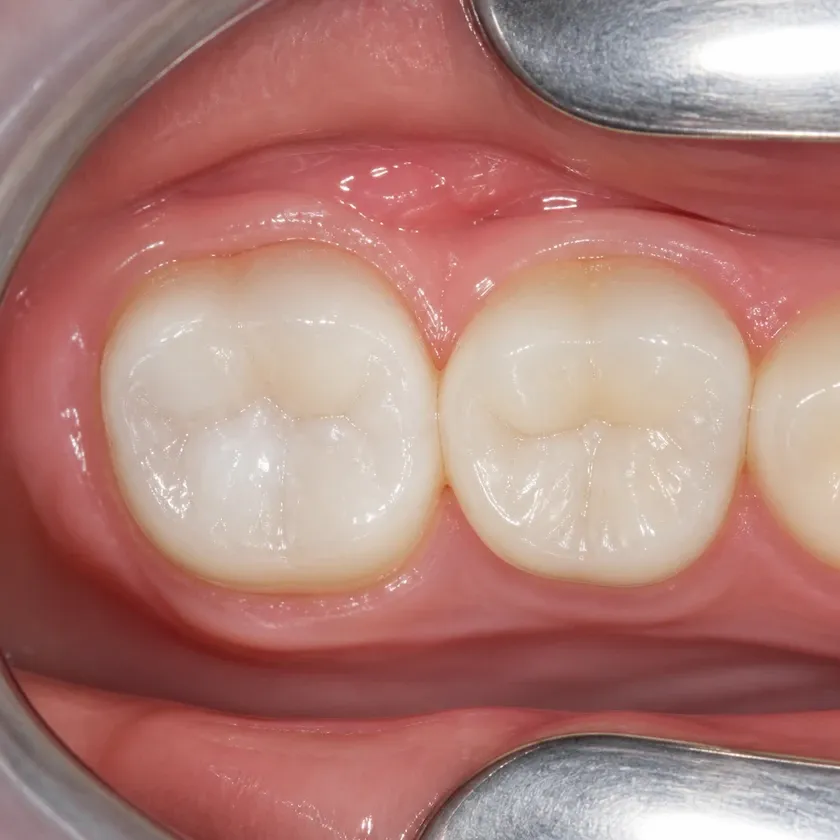 Fluoridation of primary teeth — close-up clinical photograph of the treatment result