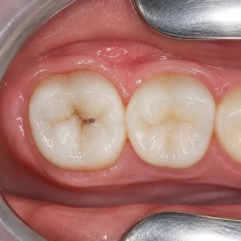 Fluoridation of primary teeth — pre-treatment condition on a clinical image