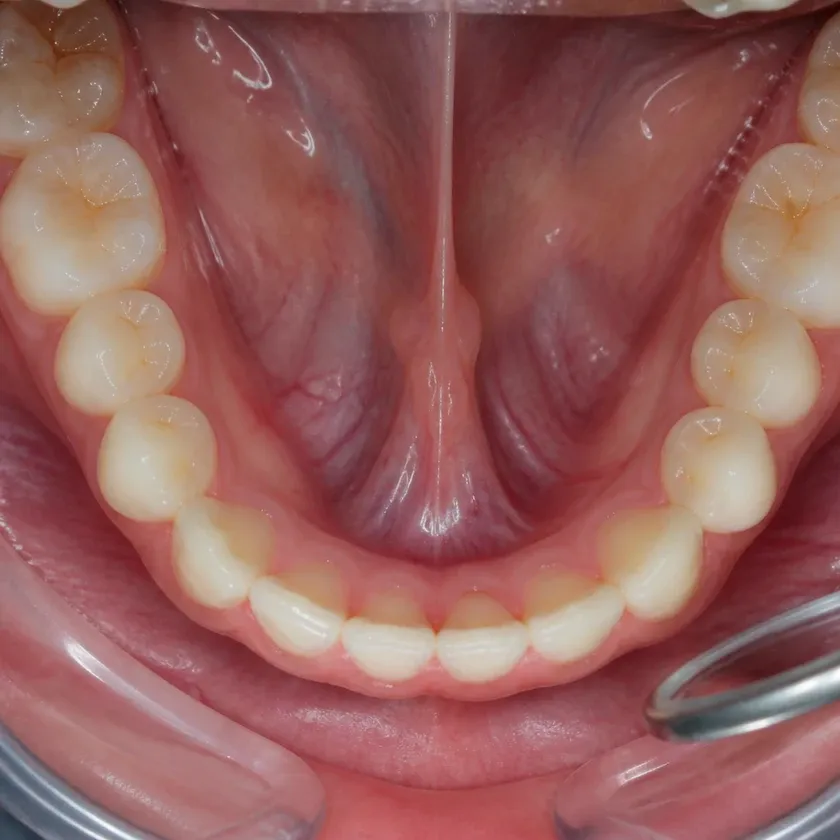 Gingivoplasty — close-up clinical photograph of the result after treatment