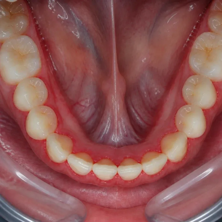 Gingivoplasty — pre-treatment condition in the clinical photograph