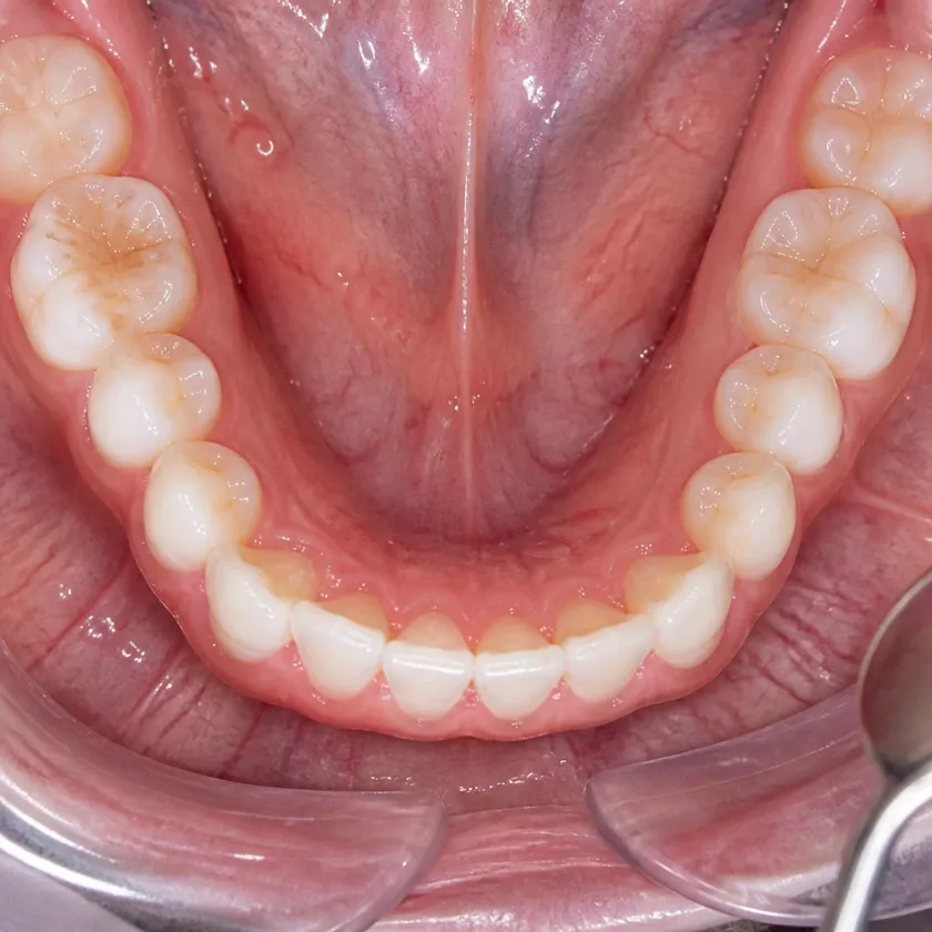 Gingivoplasty — close-up clinical photograph of the result after treatment