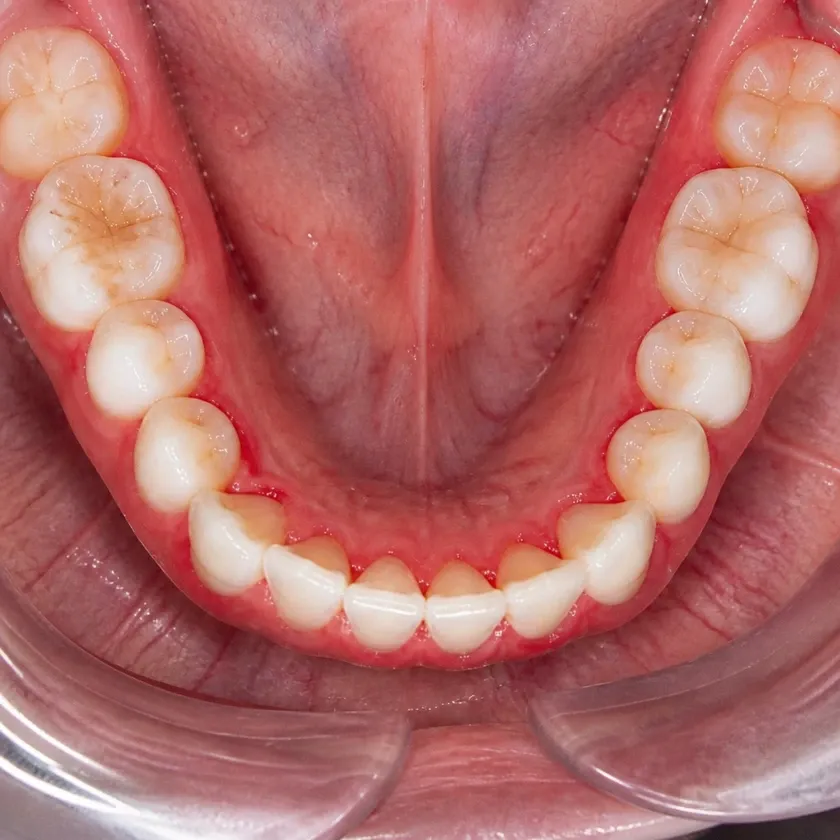 Gingivoplasty — pre-treatment condition in the clinical photograph