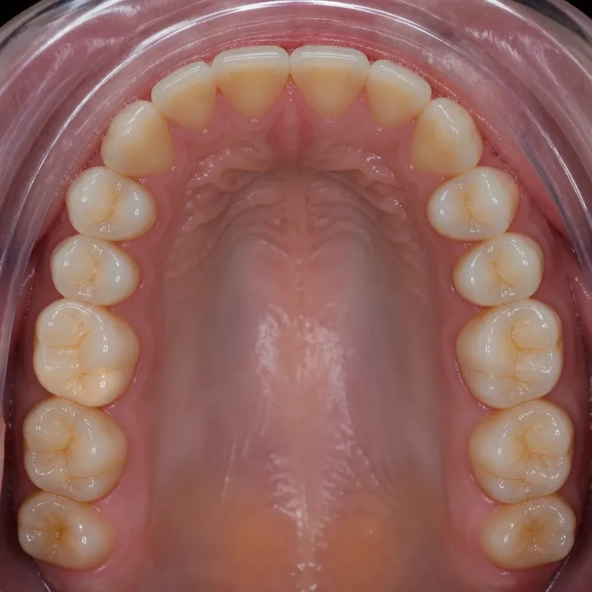 Gingivoplasty — close-up clinical photograph of the result after treatment