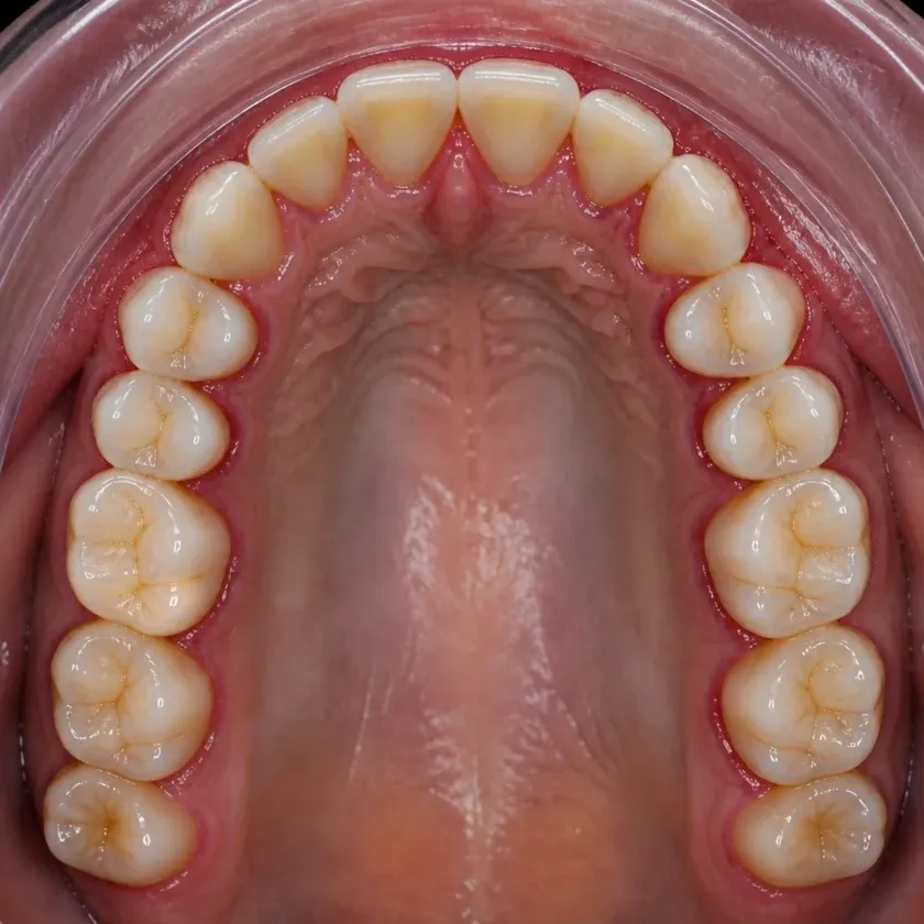 Gingivoplasty — pre-treatment condition in the clinical photograph