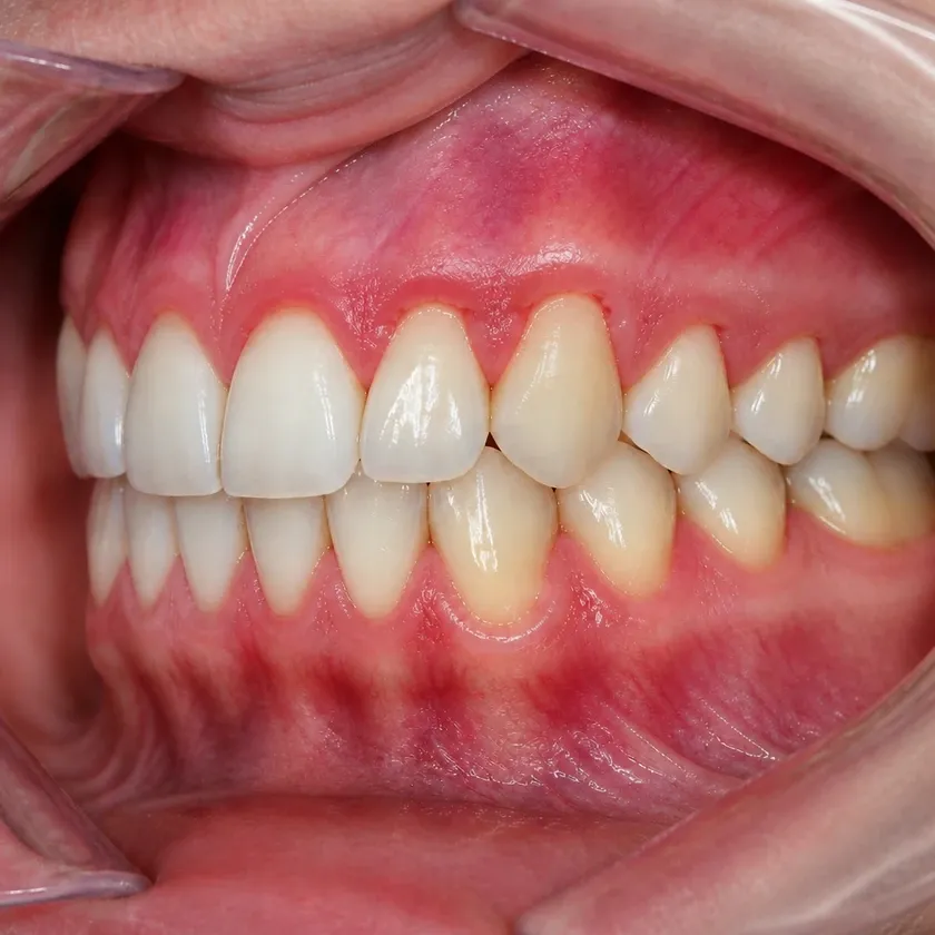 Gingivoplasty — pre-treatment condition in the clinical photograph