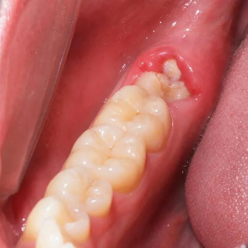 Partially erupted wisdom tooth with inflamed operculum