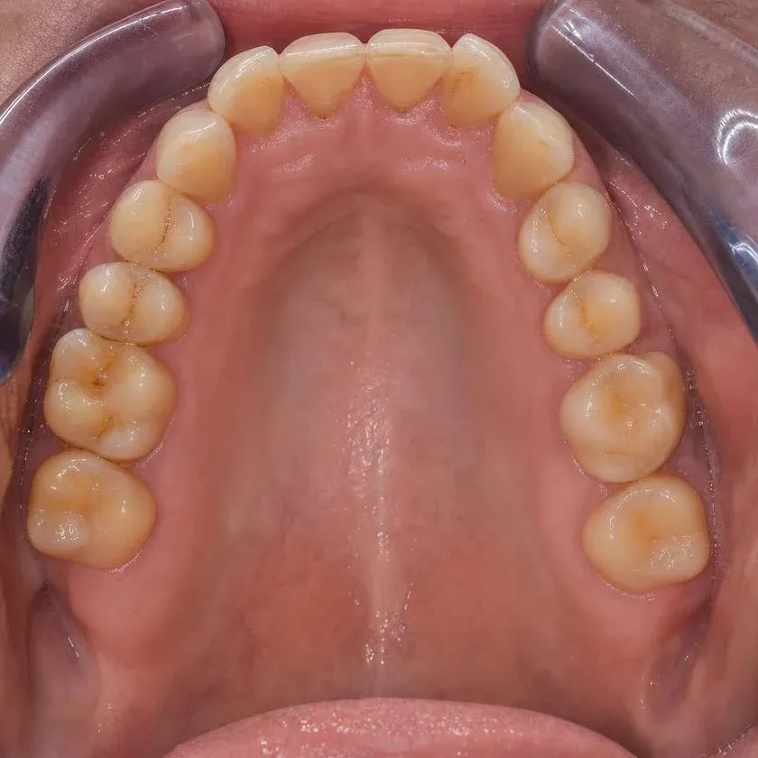 Wide bone ridge after augmentation