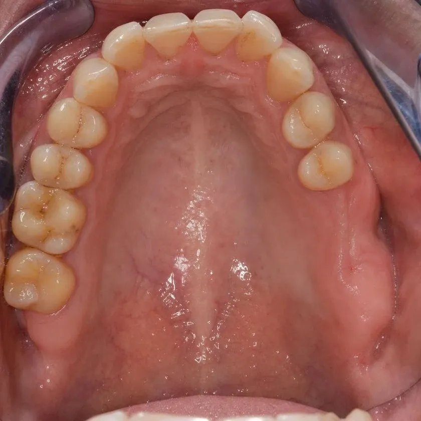 Narrow atrophic ridge at the site of a missing tooth