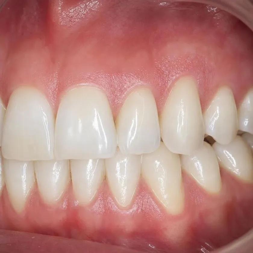 The gum covers the canine root after grafting