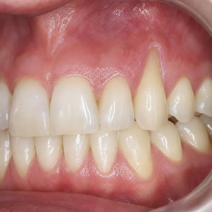 Exposed canine root due to gum recession