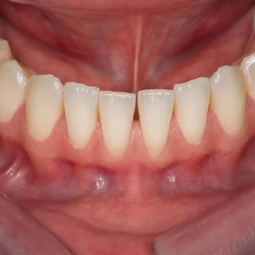 Free frenulum and even gums between the incisors
