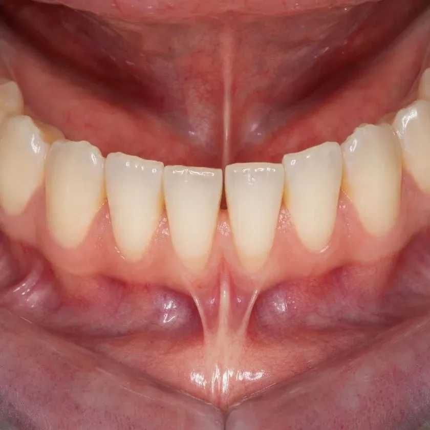 Short frenulum pulling the gum between the lower incisors