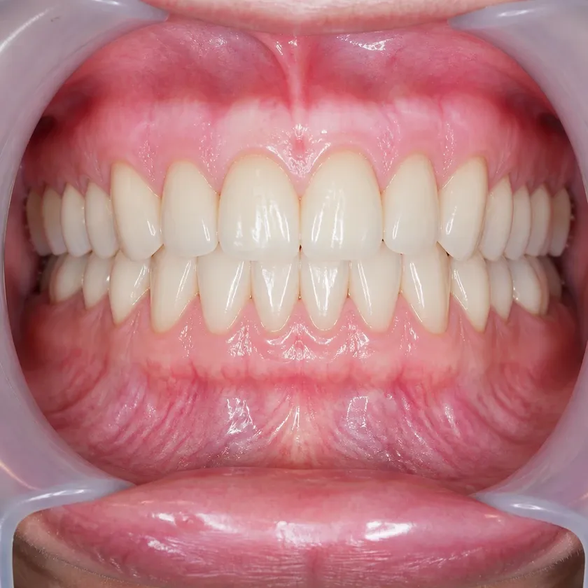Korean implant — close-up result after treatment in a clinical image