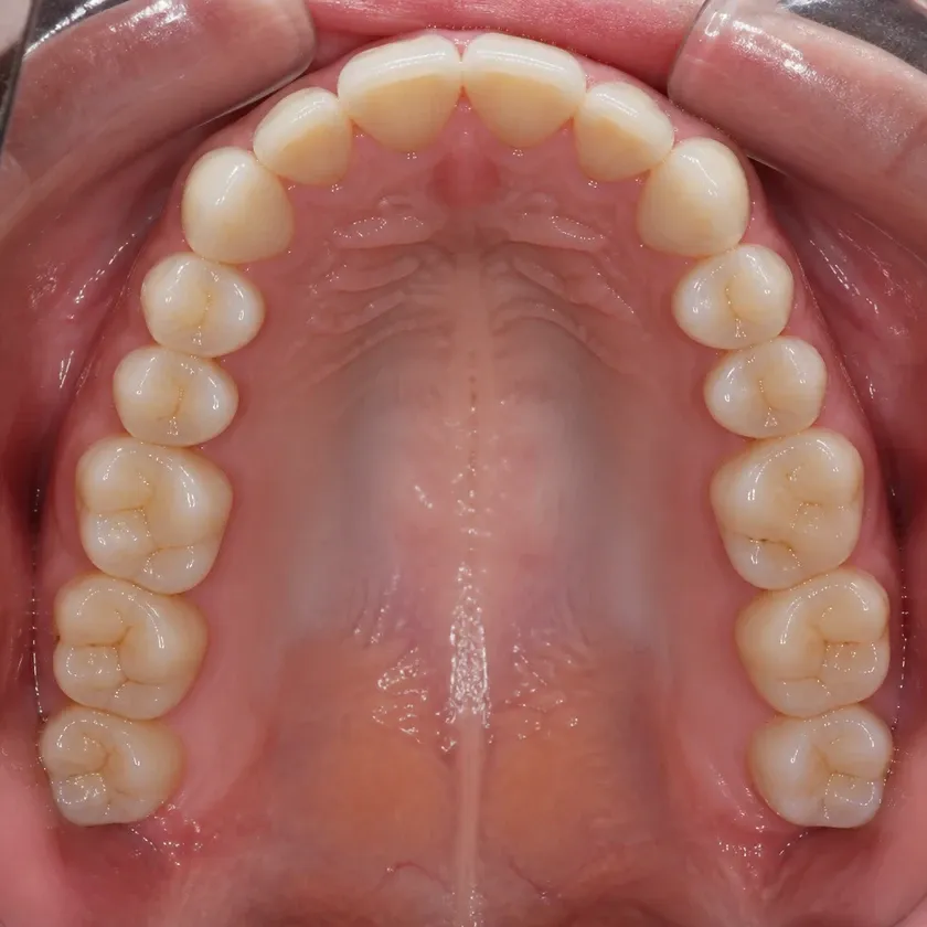 Dental implant — close-up of the treatment result on a clinical image