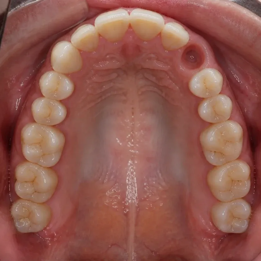 Dental implant placement — pre-treatment condition on a clinical image