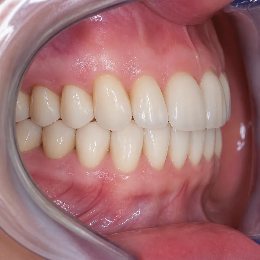 Dental implants — close-up clinical image of the result after treatment