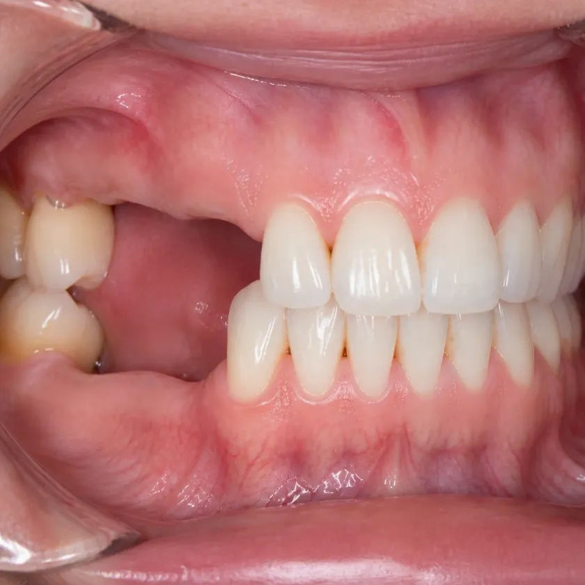 Dental implantation without surgery — pre-treatment condition on a clinical image
