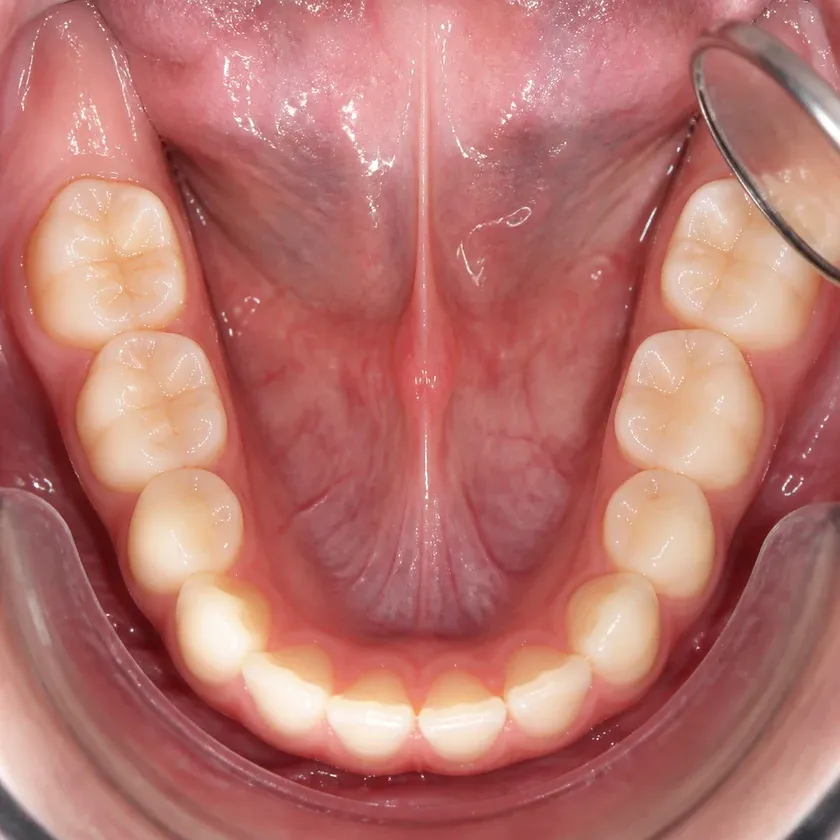 Correcting a child's bite — close-up clinical photo of the result after treatment