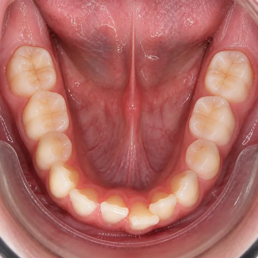 Orthodontic treatment for children — pre-treatment condition in a clinical photograph