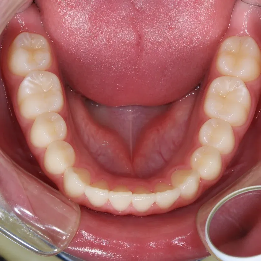 Correcting a child's bite — close-up clinical photo of the result after treatment