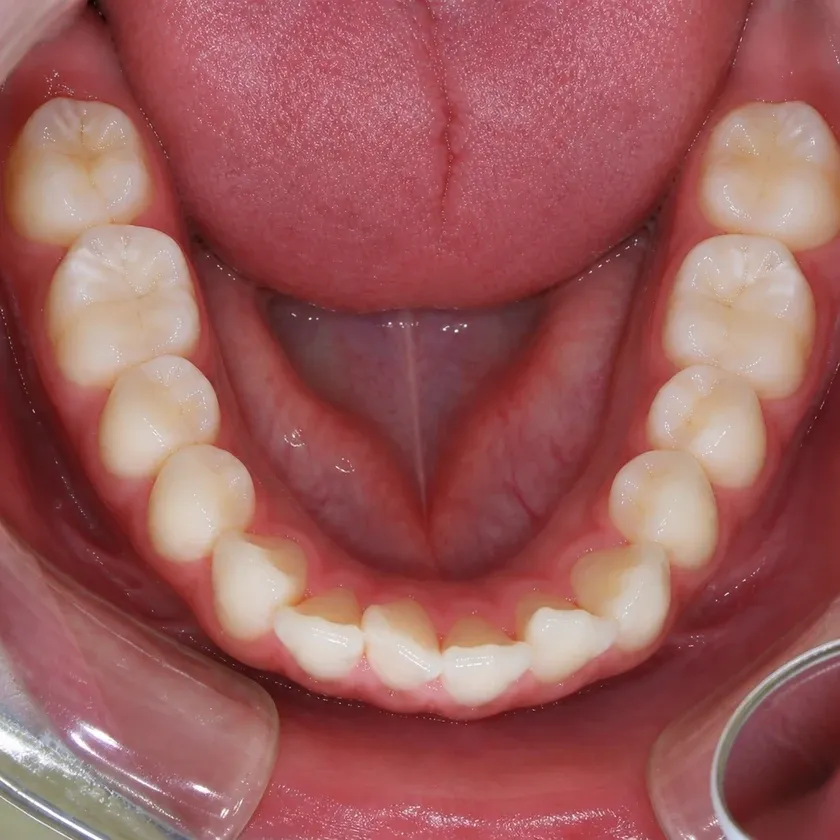 Orthodontic treatment for children — pre-treatment condition in a clinical photograph