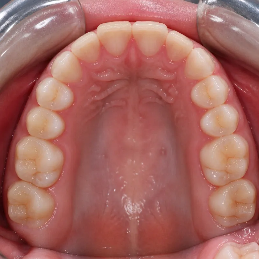 Orthodontic treatment in children — close-up clinical photo of the result after treatment