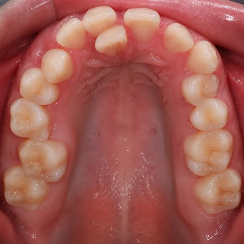Orthodontic treatment for children — pre-treatment condition in a clinical photograph