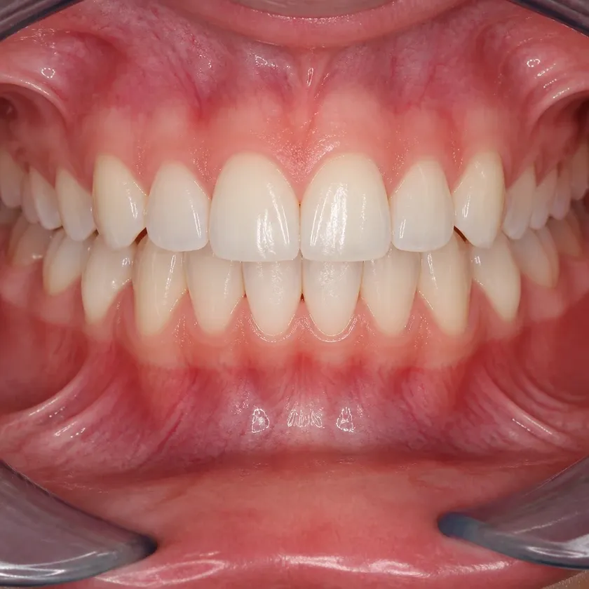 correction of a child's bite — close-up of the result after treatment in a clinical photo