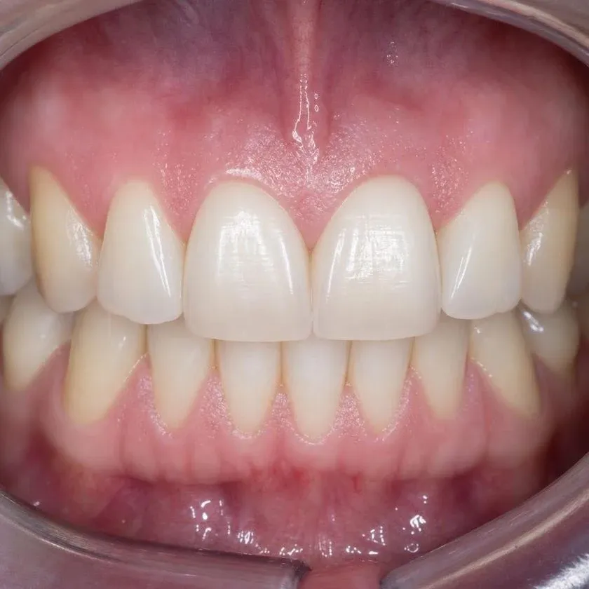 Closed dental arch after space closure