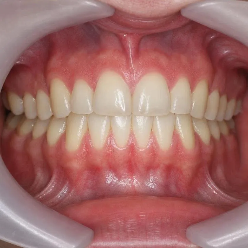 Front teeth closed together after open bite treatment