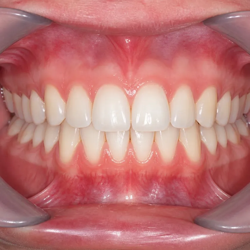 bite correction — close-up of the treatment result in a clinical photograph