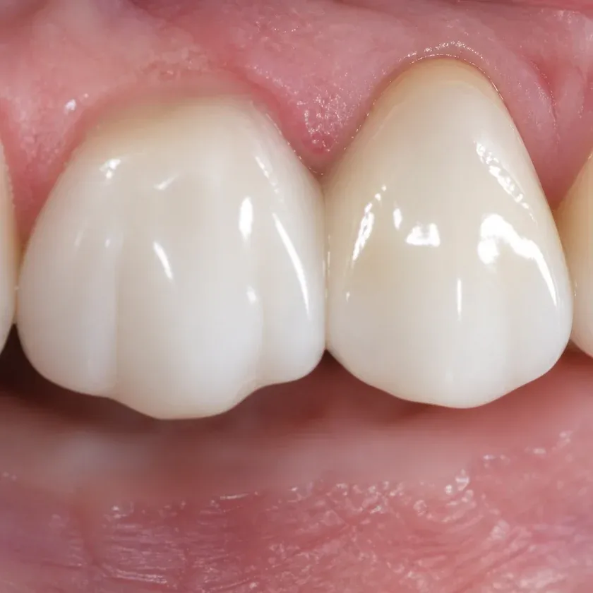 Israeli dental implants — close-up of the treatment result in a clinical photograph