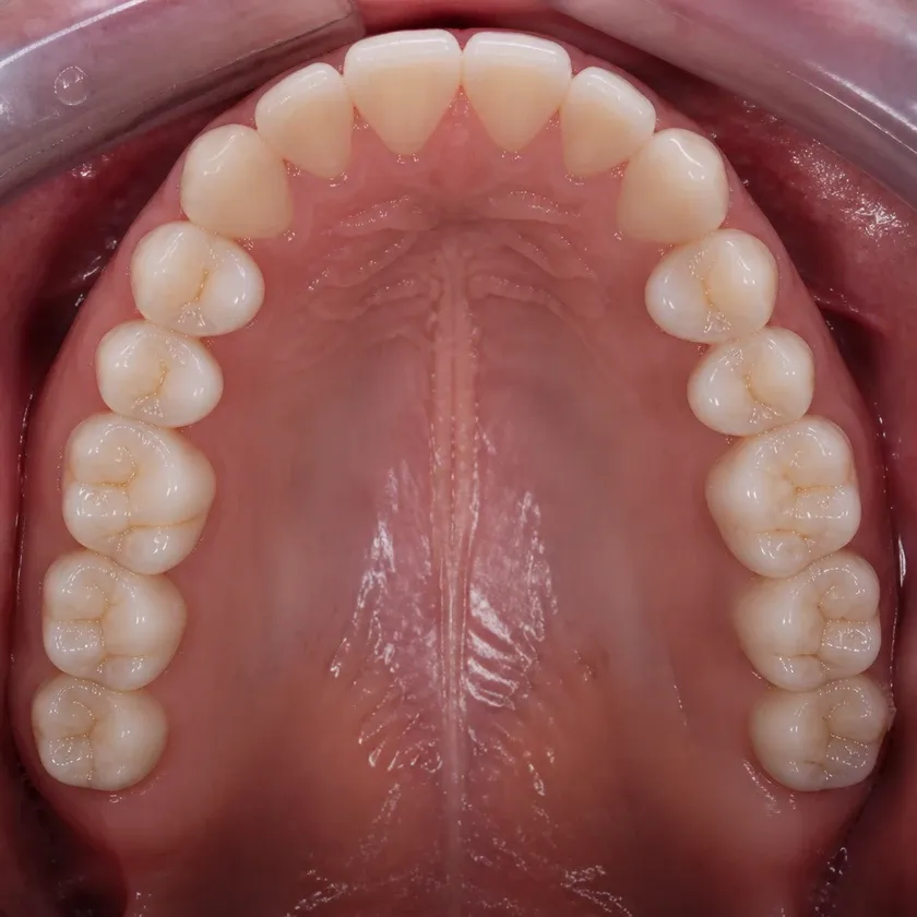 Israeli dental implants — close-up of the result after treatment in a clinical image