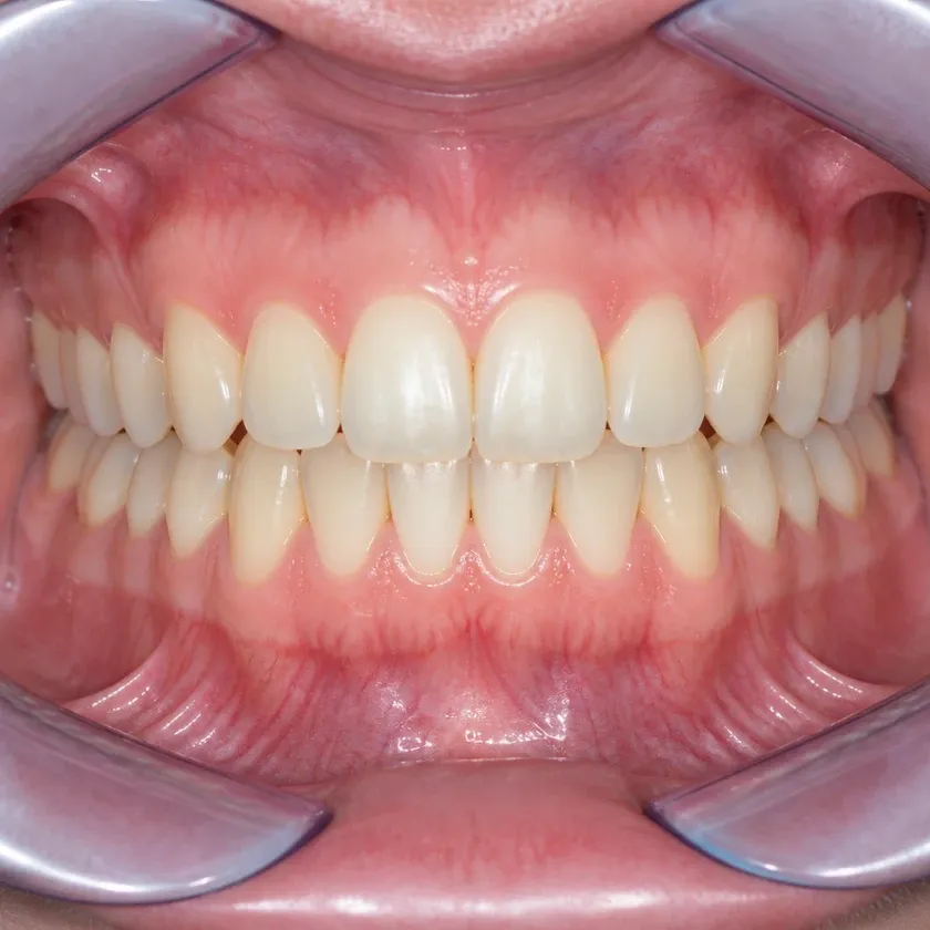 aligners for teeth straightening Astana — close-up result after treatment on a clinical image