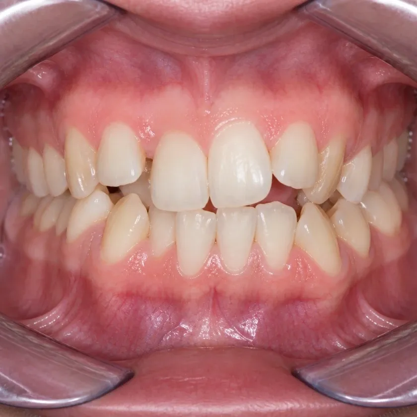 Dental aligners — before-treatment condition in a clinical photograph