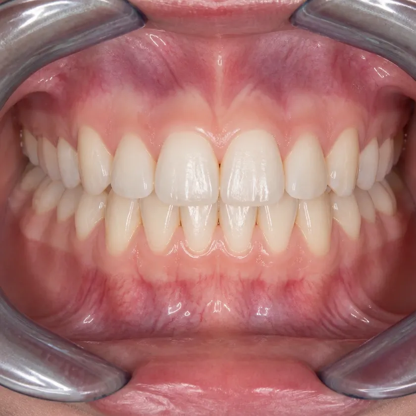 aligners for teeth straightening Astana — close-up result after treatment on a clinical image