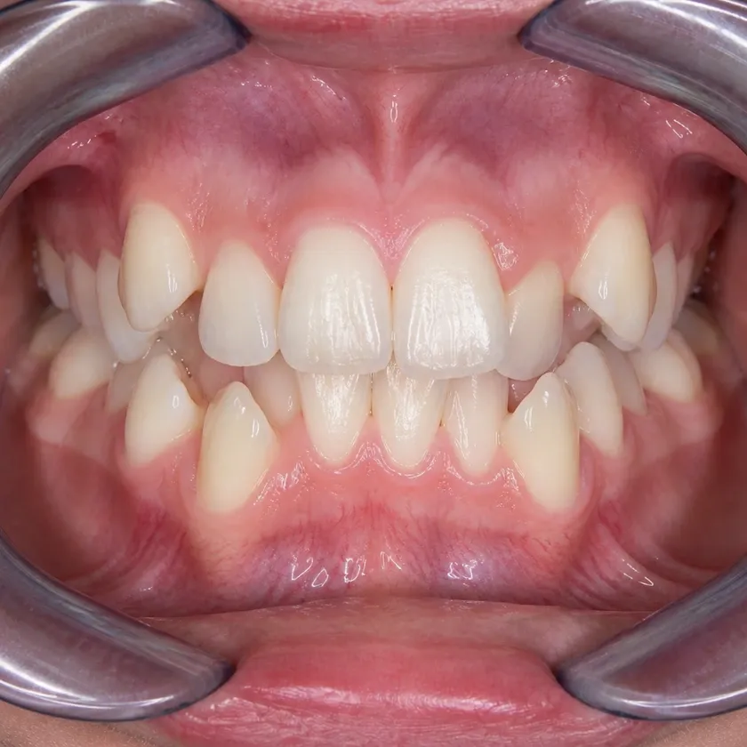 Dental aligners — before-treatment condition in a clinical photograph