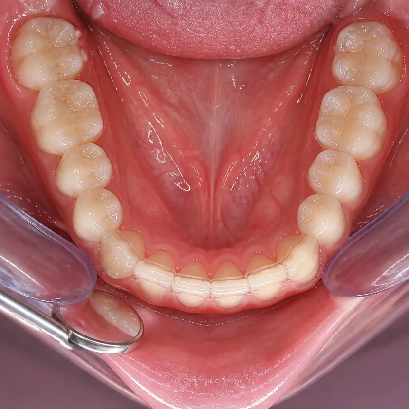 Dental aligners — close-up clinical photo of the result after treatment